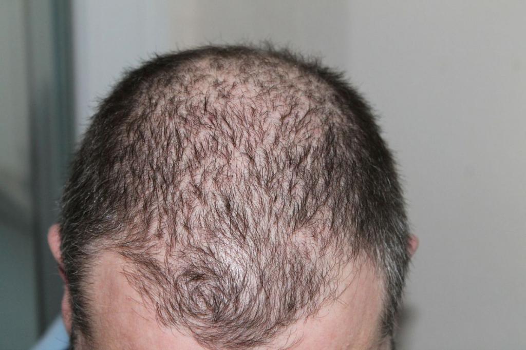 Wie Entsteht Erblich Bedingter Haarausfall